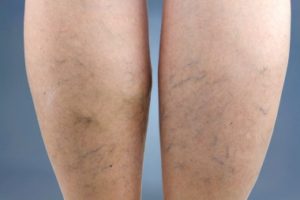 Varicose-Veins-Picture-That-Compression-Stockings-Could-Be-Used-For