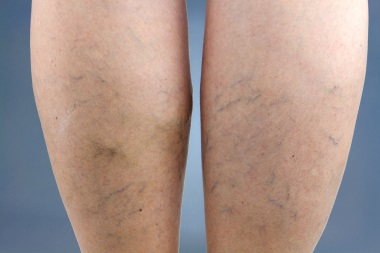 Varicose-Veins-Picture-That-Compression-Stockings-Could-Be-Used-For
