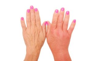 Swollen-Hand-Needs-A-Lymphedema-Glove