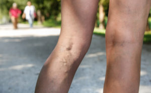 Woman-In-Park-With-Varicose-Veins