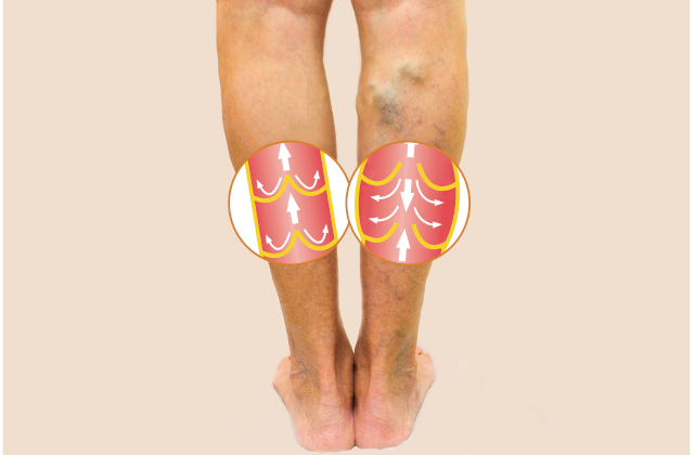 What to look for: Sock line, ankle spider veins and bulging varicose veins