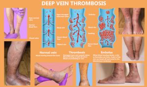 Deep-Vein-Thrombosis