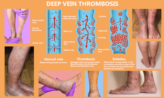 Compression Stockings for Deep Vein Thrombosis - DVT