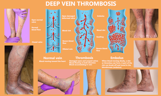 How to Spot and Prevent Deep Vein Thrombosis